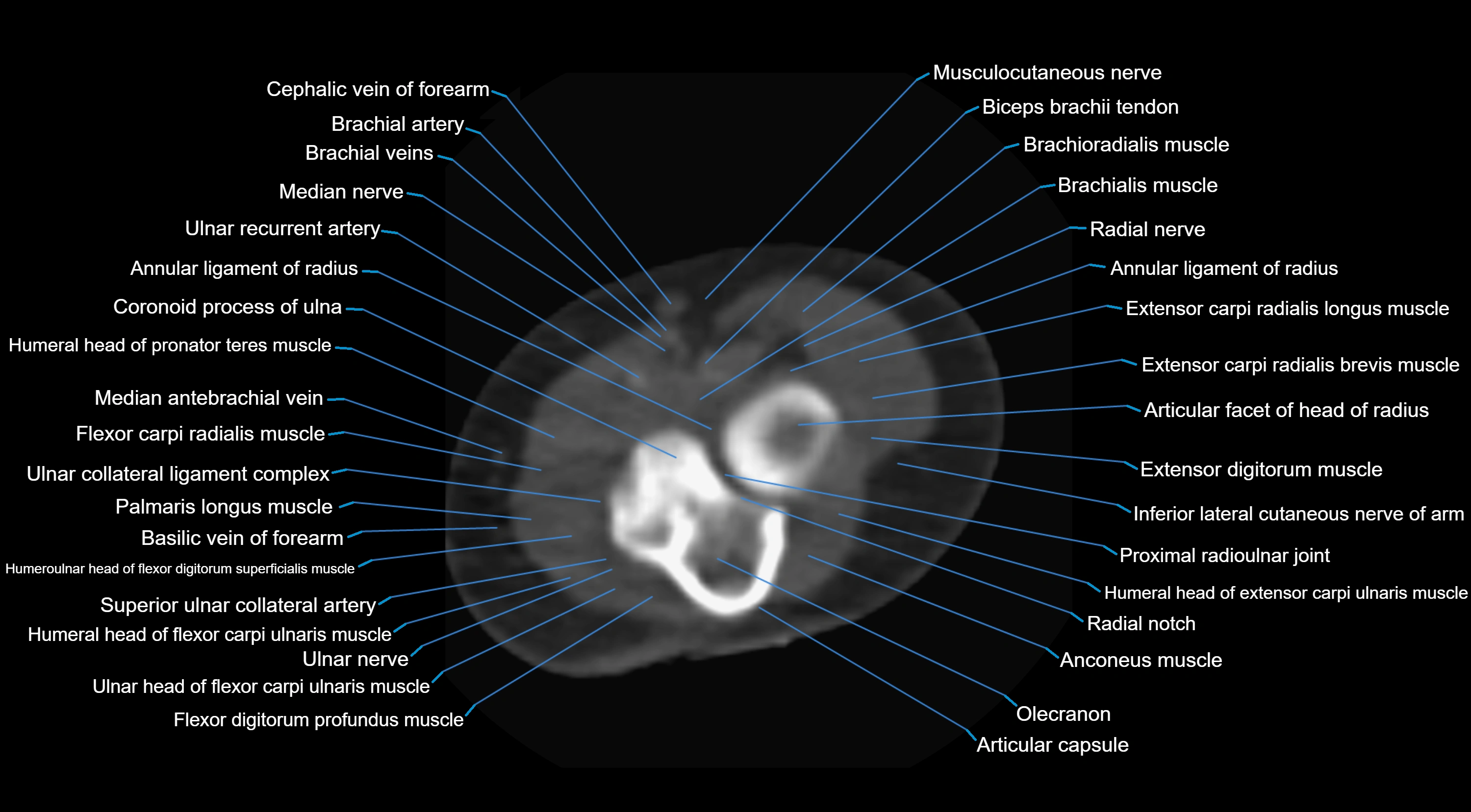 CT elbow axial  cross sectional anatomy labelled  radiology image -00029.webp